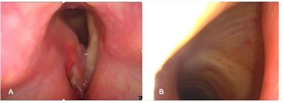 Twenty questions from the surgeon to the radiologist to better plan an open partial horizontal laryngectomy